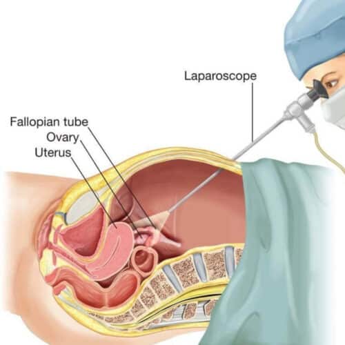 Laparoscopic Cystectomy