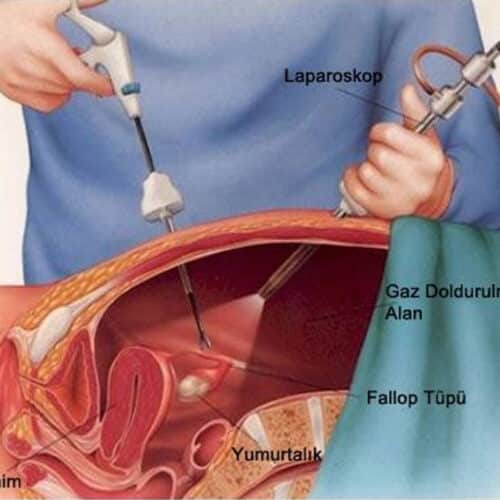 Laparoscopic Ovarian Surgery