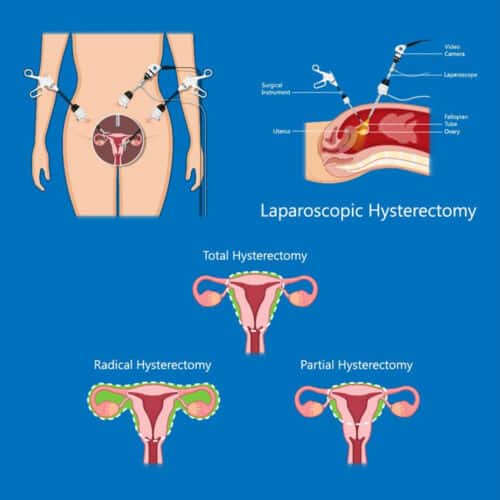 Uterine Prolapse Without Incision Surgery (Hysterectomy)