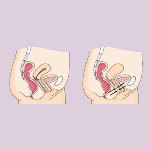 Vaginoplasty (Vagina Tightening)
